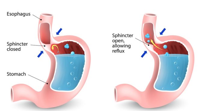 Compounding for GERD