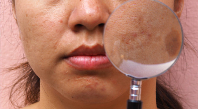 Compounding for Melasma