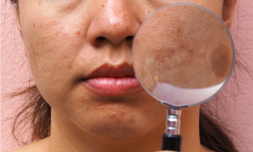 Compounding for Melasma